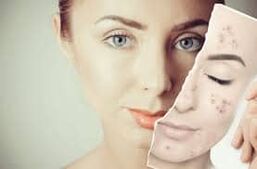 Remplacer le Botox
