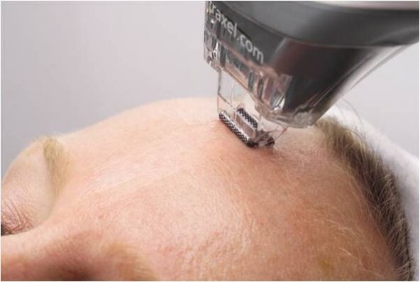 Procédure de peeling pour rajeunir la peau du visage